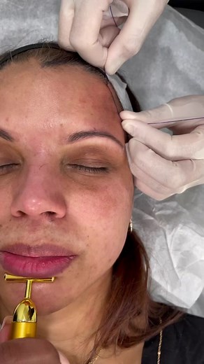 Did you know threadlifts can lift your brows, cheeks and jawline giving you a tight whole face lift? #threading #threads #threadlift #threadlifting