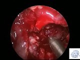Transmaxillary Approach to Infra Temporal Fossa • Video • MEDtube.net