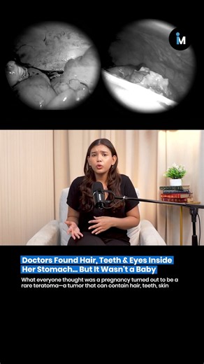 😨 Imagine going to the hospital scan reveals one of the strangest tumors known to medicine