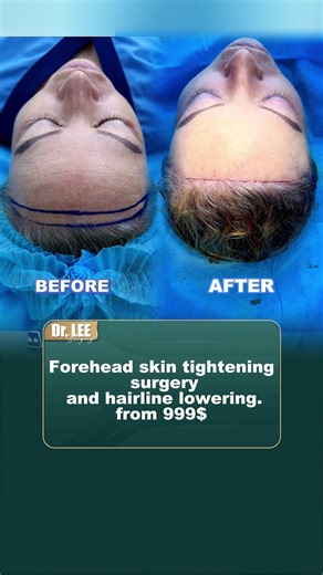 Understanding Forehead Lift Surgery