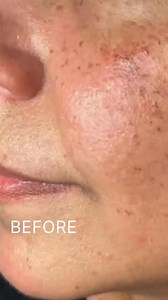 IPL results: 1 session, 4 weeks later  This before-and-after shows...