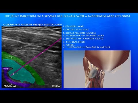 Ultrasound Guided Hip Joint Injection with in a 58 Year Old Female with a Moderate/Large Effusion