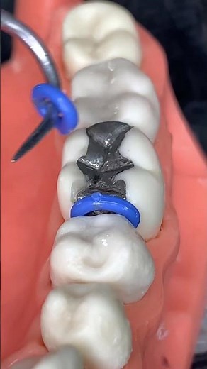 🔥Separadores Dentales / Dental Spacers🔥