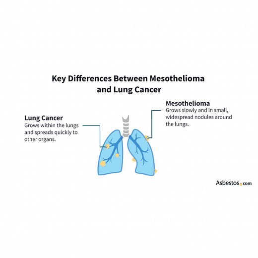 Mesothelioma vs. Lung Cancer: Differences & Similarities