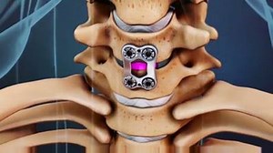 27K views · 666 shares | Anterior cervical discectomy with fusion, or...