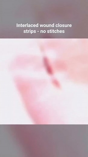Doctor sk ‍⚕️ on Instagram: "Intertwined strips. Adhesive sutures, also known as suture tapes or skin adhesives, are thin strips of adhesive material that are used to bring together and hold together the edges of cuts, wounds or incisions, aiding in the healing process."