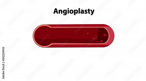 Balloon Angioplasty Procedure Animation