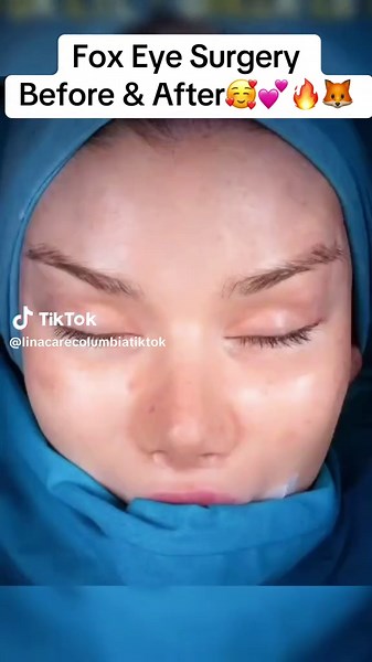 Fox Eye Surgery | Before & After 🥰💕🔥🦊 ——— #beforeandafter #comesticsurgery #foxeyesurgery #temporalfacelift #blepharoplasty #rhinoplasty #foryoupage #fyp #fy #FACESURGERY