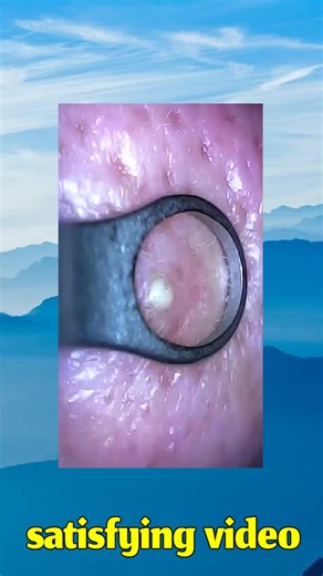 pimple acne squeezeyuk cyst popping abcess satisfying video (166)