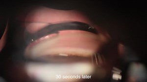 Durysta Slit Lamp: No Speculum or Second Instrument - Eyetube