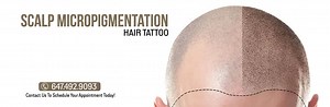 Scalp Micropigmentation: Hair Tattoo Benefits, Before & After