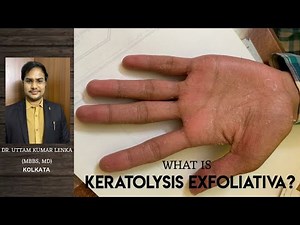 Keratolysis Exfoliativa(Repeated peeling of skin from palm and sole) Hath aur paw se Chamdi Nikalna.