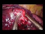Uniportal VATS Right Anterobasal Anatomic Segmentectomy (S8) • Video • MEDtube.net