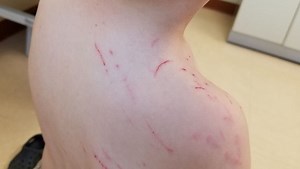 When squirrels attack: Boy, 4, suffers cuts and scratches
