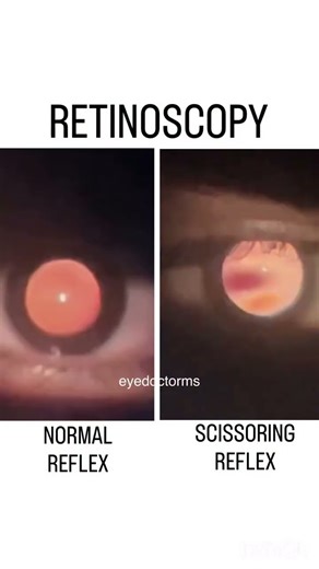 Retinoscopy #eyes #eyedoctor #ms #eyetest #optometrist