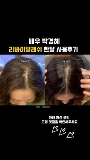 머리카락이 막 나고 있어요! 한 달 사용 후기