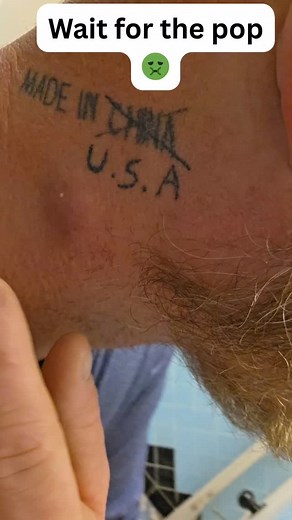 Pimple Popping on Instagram