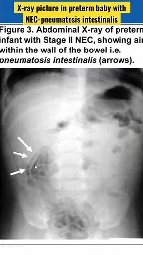 X-ray picture in preterm baby with NEC-pneumatosis intestinalis #NEC #necrotisingenterocolits