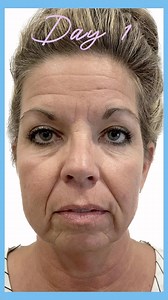 A great transformation in just under a month. Vsoft PDO lifting and smoothing threads with some Juvaderm Ultra Plus and Botox works like a charm. Will still fine tune a little bit. But this patient is thrilled when she looks in the mirror! #vsoftliftusa #allerganbotox #juvaderm | Bella Facial Esthetics