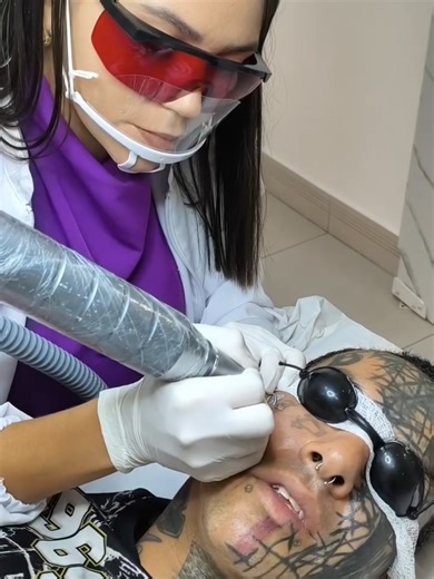Remoção de tatuagem facial a Laser. #remocaodetatuagem #remocaoalaser #remocaotatuagem #abc