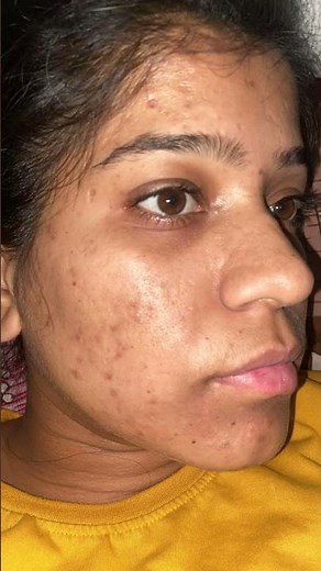 Tretinoin cream 0.025% transformation No acne No dark spot #acne #skincare #tretinoin #darkspots