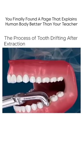 medical/health on Instagram: "This anatomical animation illustrates the physiological response of the human jaw and dental arch following a tooth extraction. The video clearly shows the process of dental migration or drifting, where surrounding teeth move out of their stable positions to fill the void. This phenomenon can lead to misalignment, bite problems, and potential issues with the temporomandibular joint (TMJ) if not addressed by an orthodontic or prosthetic solution."