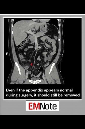 Acute Appendicitis CT Scan