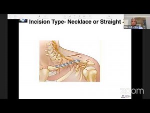 Clavicle fractures: Do we need to fix them all?