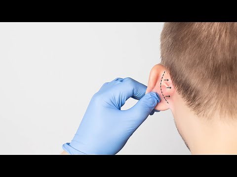 Otoplasty EAR SURGERY