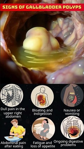 Do You Have Gallbladder Polyps? 6 Signs Your Body Is Warning You