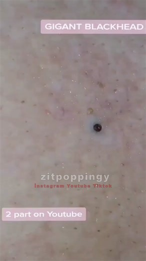 Welcome to the relaxing world of pimple popping videos. It's time to de-stress, relieve tension, and take the right steps towards clearer skin. Indulge in my pimple popping videos and watch your skin transform into a healthier, clearer version of itself. Follow me and stay tuned for my future videos. Sivilce sıkma videosunun rahatlatıcı dünyasına hoş geldiniz. Stresten arınmanın, gerilimi atmanın ve cildinizin sağlığı için doğru adımlar atmanın zamanı geldi. Sivilce sıkma videolarımla kendinizi 