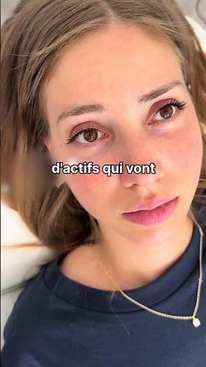 Understanding Your Under-Eye Circles to Treat Them Better