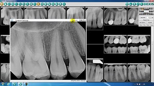 Images Disappear In Dexis