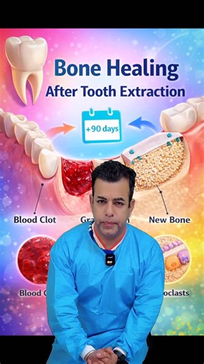 🦷 Tooth Extraction Healing: The 90-Day Story Beneath the Gums After a tooth is removed, most people are advised to wait a few months before considering an implant. But healing isn’t just about waiting — it’s about what the body is actually doing during that time. Inside the socket, several changes happen together: • A blood clot forms to start healing • Soft healing tissue replaces the clot • Tooth-dependent bone begins to disappear • New bone forms, while the ridge slowly shrinks By around 90