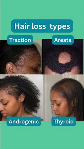 Which type of alopecia do you have? #dermatology #alopecia #health