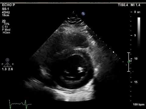 [Echo Case Review] severe LV systolic dysfunction