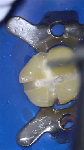 Old e.max Crown Removal 😳 | What Lies Beneath?