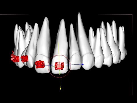 Placing orthodontic brackets on central incisors