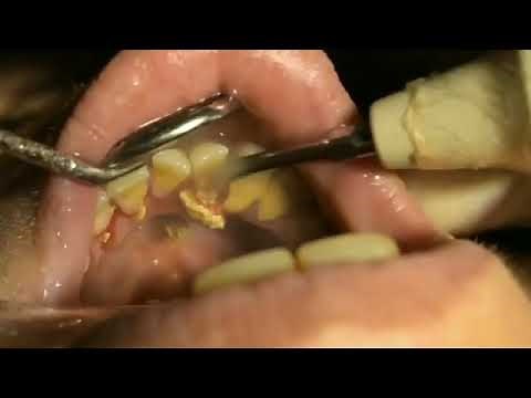 Dental Scale & Polish