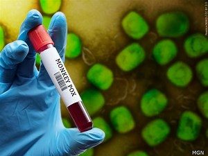 Monkeypox: understanding prevention and treatment options