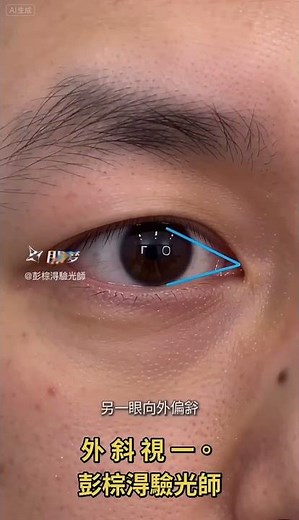 雙眼視覺障礙之外斜視 #彭棕淂 #驗光師 #東京隱形眼鏡 #外斜視 #竹東鎮眼鏡行