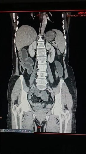 CECT Whole abdomen.#viral #anatomy #shortsfeed #trend #shortsviral #shorts#pelvicbone #abdomen#feed