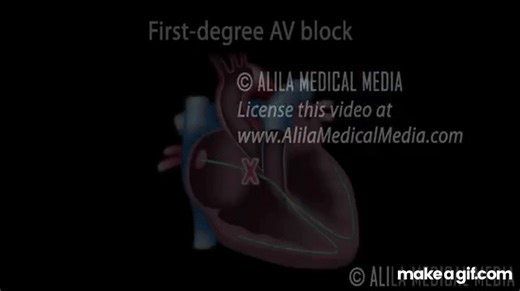 Heart Blocks, Anatomy and ECG Reading, Animation. on Make a GIF