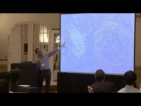 Ahmet Dogan - Castleman Disease Pathology and Diagnosis