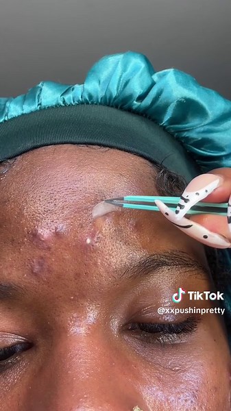 Satisfying Pimple Patch Removal by Pretty Thawani