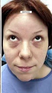 Lower blepharoplasty with fat repositioning,fat grafting to midface and cheek,and co2 laser