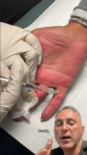 Botulinum Toxin Injections for Sweaty Hands