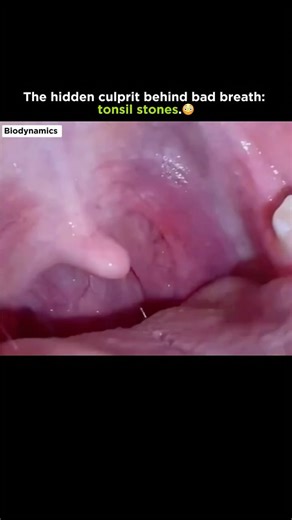 Medical | Science | Facts on Instagram: "Tonsil stones are small, hardened deposits that form in the tonsil pockets due to trapped food, bacteria, and mucus. They can cause bad breath, throat irritation, and discomfort. In this video, you’ll see how a tonsil stone is safely removed to relieve symptoms and improve oral hygiene. . . . #trendingreels #didyouknow #intresting #medicalfacts #biologyfacts #humanbody #science #disease #disorder #doctor #explore #viral #knowledge #usa #tonsilstone"