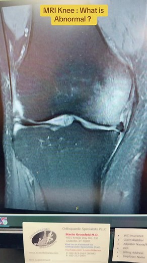 Whatnis abnormal on this MRI of the knee ? Dr Stacie Grossfeld , orthopedic surgeon describes. #orthopedicsurgeon #medicalstudent #ladypod #physicianassistantstudent #doctorsoftiktok #atc #mri #knee #kneeinjury #mritech #radtech #radtechstudent #kneepain