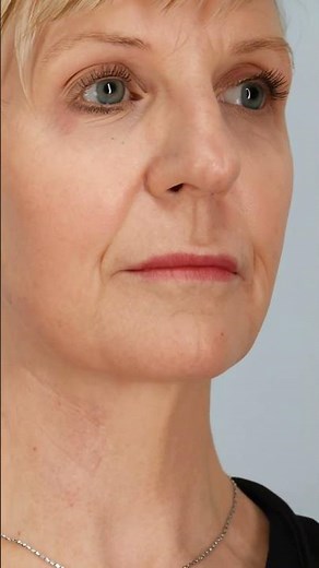 Neck Lift Transformation